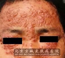 轻度红斑狼疮图片